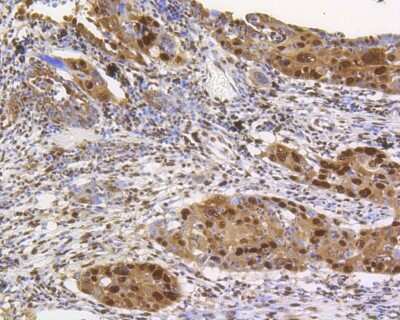 Immunohistochemistry-Paraffin: CREB Antibody (SA04-04) [NBP2-67274] - Immunohistochemical analysis of paraffin-embedded human lung carcinoma tissue using anti-CREB antibody. The section was pre-treated using heat mediated antigen retrieval with Tris-EDTA buffer (pH 8.0-8.4) for 20 minutes. The tissues were blocked in 5% BSA