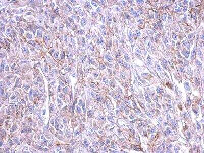 Immunohistochemistry-Paraffin: CRHR1/CRF1 Antibody [NBP2-16010] - HeLa xenograft, using CRFR1 antibody at 1:500 dilution.  Antigen Retrieval: Trilogy™ (EDTA based, pH 8.0) buffer, 15min.