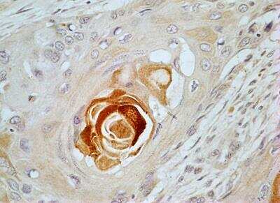 Immunohistochemistry-Paraffin: CRLF2 Antibody [NBP2-29613] - IHC-P analysis of CRLF2 protein in a tissue section of esophageal squamous cell carcinoma using CRLF2 antibody at a concentration of 5 ug/ml. The representative image shows a well-differentiated squamous area with distinct squamous pearl or keratin pearl formation which developed intense staining. 