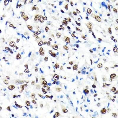 Immunohistochemistry-Paraffin: CRM1 Antibody (1J0L10) [NBP3-15823] - Immunohistochemistry of paraffin-embedded human liver cancer using CRM1 antibody (NBP3-15823) at dilution of 1:100 (40x lens).Perform microwave antigen retrieval with 10 mM PBS buffer pH 7.2 before commencing with IHC staining protocol.