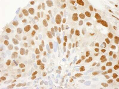 Immunohistochemistry: CRM1 Antibody [NB100-40862] - Sample: FFPE section of human breast tumor. Antibody: Affinity purified rabbit anti-CRM1 used at a dilution of 1:250. Detection: DAB staining using Immunohistochemistry Accessory Kit .