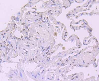 Immunohistochemistry-Paraffin: CRM1 Antibody (JB35-22) [NBP2-75448] - Analysis of paraffin-embedded human lung cancer tissue using anti-CRM1 antibody. Counter stained with hematoxylin.