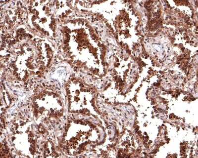 Immunohistochemistry-Paraffin: CRM1 Antibody (JB35-22) [NBP2-75448] - Analysis of paraffin-embedded human lung carcinoma tissue with Rabbit anti-CRM1 antibody washed with ddH2O and PBS, and then probed with the primary antibody at 1/400 dilution for 1 hour at room temperature. The detection was performed using an HRP conjugated compact polymer system. DAB was used as the chromogen. Tissues were counterstained with hematoxylin and mounted with DPX.