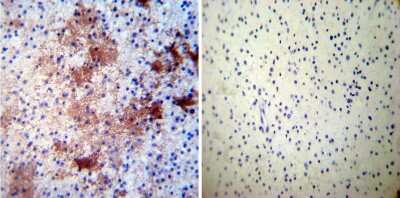 Immunohistochemistry-Paraffin: CRMP5 Antibody (CR-1) [NB100-74395] - Biopsies of deparaffinized Human glioma tissue.