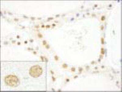 Immunohistochemistry-Paraffin: CROP Antibody [NB100-74625] - FFPE section of human thyroid carcinoma.  Affinity purified rabbit anti-CROP/Luc7A  used at a dilution of 1:250.