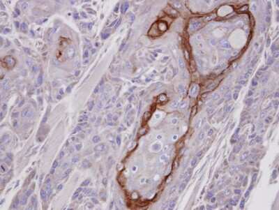 Immunohistochemistry-Paraffin: CROT Antibody [NBP1-31441] - Paraffin-embedded Ca922 xenograft, using antibody at 1:100 dilution.