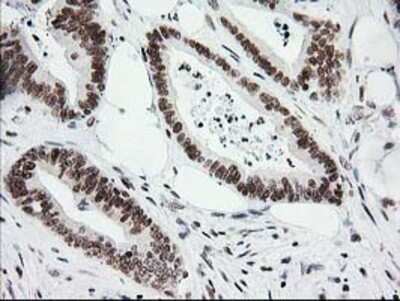 Immunohistochemistry: CRY2 Antibody (OTI1H5) - Azide and BSA Free [NBP2-70449] - Staining of paraffin-embedded Adenocarcinoma of Human colon tissue using anti-CRY2 mouse monoclonal antibody.