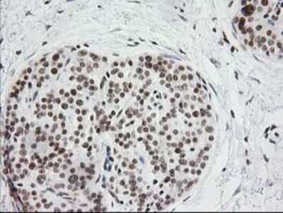 Immunohistochemistry: CRY2 Antibody (OTI1H5) - Azide and BSA Free [NBP2-70449] - Staining of paraffin-embedded Carcinoma of Human pancreas tissue using anti-CRY2 mouse monoclonal antibody.