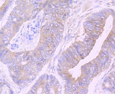 Immunohistochemistry-Paraffin: CSE1L/CAS/Exportin-2 Antibody (JU34-33) [NBP2-75451] - Analysis of paraffin-embedded human colon cancer tissue using anti-Cellular Apoptosis Susceptibility antibody. Counter stained with hematoxylin.