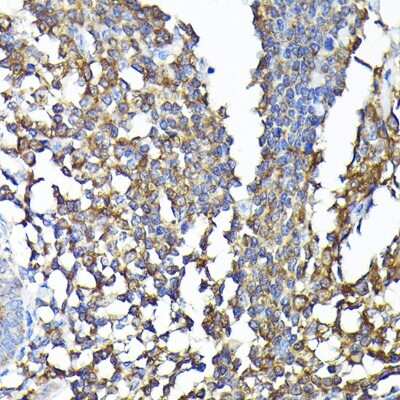 Immunohistochemistry-Paraffin: CSK Antibody [NBP2-92944] - Immunohistochemistry of paraffin-embedded human colon carcinoma using [KO Validated] CSK Rabbit pAb (NBP2-92944) at dilution of 1:100 (40x lens). Perform high pressure antigen retrieval with 10 mM citrate buffer pH 6.0 before commencing with IHC staining protocol.