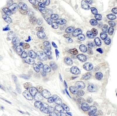 <b>Biological Strategies Validation. </b>Immunohistochemistry: CSN1 Antibody [NB100-362] - Sample: FFPE section of human prostate carcinoma. Antibody: Affinity purified rabbit anti-CSN1 used at a dilution of 1:1,000 (1ug/ml). Detection: DAB