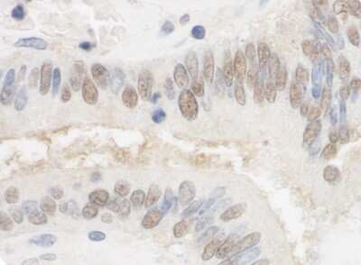 <b>Biological Strategies Validation. </b>Immunohistochemistry: CSTF2T Antibody [NB100-74614] - Sample: FFPE section of human colon carcinoma. Antibody: Affinity purified rabbit anti-CSTF2T/TauCSTF64 used at a dilution of 1:1,000 (1ug/ml). Detection: DAB