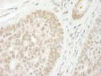 Immunohistochemistry-Paraffin: CSTF2T Antibody [NB100-74614] - FFPE section of human skin squamous cell carcinoma.   NB100-74614 used at a dilution of 1:250.  DAB staining using Immunohistochemistry Accessory Kit