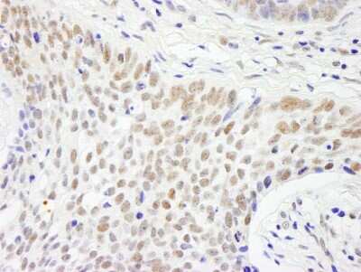 Immunohistochemistry-Paraffin: CSTF2T Antibody [NB100-74614] - Human skin basal cell carcinoma. Antibody used at a dilution of 1:1000 (1ug/ml).