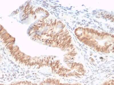 Immunohistochemistry-Paraffin: CSTF2T Antibody (PCRP-CSTF2T-1A3) [NBP3-08807] - Formalin-fixed, paraffin-embedded human colon adenocarcinoma stained with CSTF2T Mouse Monoclonal Antibody (PCRP-CSTF2T-1A3).
