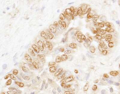 <b>Independent Antibodies Validation and Biological Strategies Validation.</b>Immunohistochemistry: CSTF3 Antibody [NB100-57532] - Sample: FFPE section of human prostate carcinoma. Antibody: Affinity purified rabbit anti-CSTF77 used at a dilution of 1:2 00 (1ug/ml). Detection: DAB