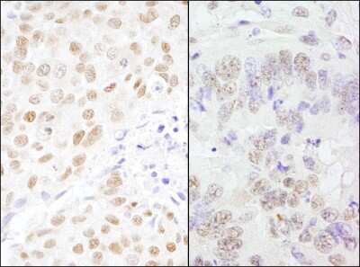 <b>Independent Antibodies Validation and Biological Strategies Validation.</b>Immunohistochemistry: CSTF3 Antibody [NB100-57534] - Sample: FFPE section of human breast carcinoma (left) and mouse teratoma (right). Antibody: Affinity purified rabbit anti-CSTF77 used at a dilution of 1:200 (1ug/ml). Detection: DAB