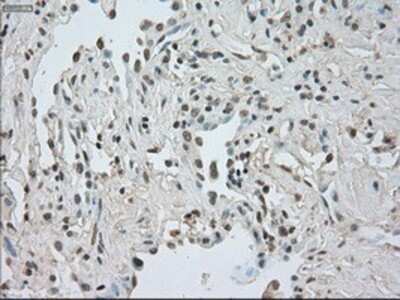 Immunohistochemistry: CTAG1B Antibody (OTI2B6) - Azide and BSA Free [NBP2-70485] - Staining of paraffin-embedded Carcinoma of lung tissue using anti-CTAG1B mouse monoclonal antibody.