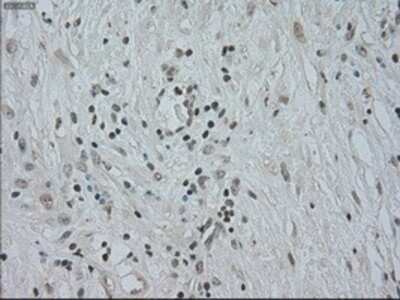 Immunohistochemistry: CTAG1B Antibody (OTI2B6) - Azide and BSA Free [NBP2-70485] - Staining of paraffin-embedded Carcinoma of pancreas tissue using anti-CTAG1B mouse monoclonal antibody.