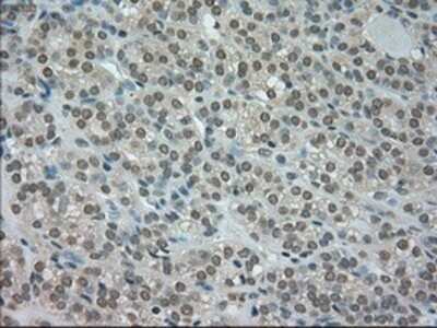 Immunohistochemistry: CTAG1B Antibody (OTI2B6) - Azide and BSA Free [NBP2-70485] - Staining of paraffin-embedded Carcinoma of thyroid tissue using anti-CTAG1Bmouse monoclonal antibody.