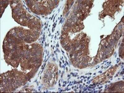 Immunohistochemistry: CTAG1B Antibody (OTI5H4) - Azide and BSA Free [NBP2-70486] - Analysis of Adenocarcinoma of Human ovary tissue. (Heat-induced epitope retrieval by 10mM citric buffer, pH6.0, 120C for 3min)