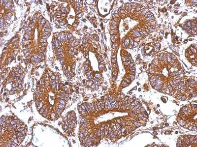 Immunohistochemistry-Paraffin: CTAGE5 Antibody [NBP2-16022] - Immunohistochemical analysis of paraffin-embedded Colon ca, using antibody at 1:500 dilution.