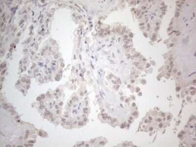 Immunohistochemistry: CTBP2 Antibody (4D4) [NBP2-46390] - Analysis of Carcinoma of Human thyroid tissue. (Heat-induced epitope retrieval by 1mM EDTA in 10mM Tris buffer (pH8.5) at 120C for 3 min)