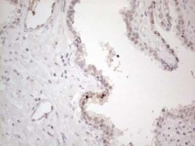 Immunohistochemistry: CTBP2 Antibody (4D4) [NBP2-46390] - Analysis of Carcinoma of Human prostate tissue. (Heat-induced epitope retrieval by 1mM EDTA in 10mM Tris buffer (pH8.5) at 120C for 3 min)