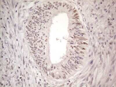 Immunohistochemistry: CTBP2 Antibody (OTI4D4) - Azide and BSA Free [NBP2-70487] - Analysis of Adenocarcinoma of Human colon tissue. (Heat-induced epitope retrieval by 1mM EDTA in 10mM Tris buffer (pH8.5) at 120C for 3 min)