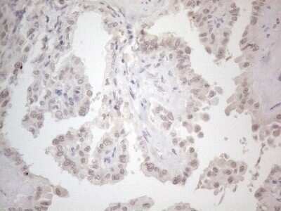 Immunohistochemistry: CTBP2 Antibody (OTI4D4) - Azide and BSA Free [NBP2-70487] - Analysis of Carcinoma of Human thyroid tissue. (Heat-induced epitope retrieval by 1mM EDTA in 10mM Tris buffer (pH8.5) at 120C for 3 min)