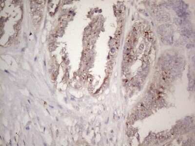 Immunohistochemistry: CTDSP2 Antibody (7F5) [NBP2-46391] - Analysis of Adenocarcinoma of Human ovary tissue. (Heat-induced epitope retrieval by 1mM EDTA in 10mM Tris buffer (pH8.5) at 120C for 3 min)