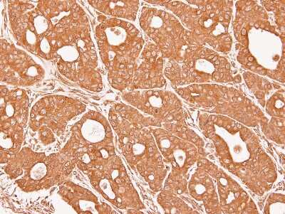 Immunohistochemistry-Paraffin: CTNNA3 Antibody [NBP2-16030] - Immunohistochemical analysis of paraffin-embedded NCI-N87 xenograft, using antibody at 1:100 dilution.