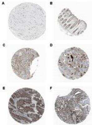 Immunohistochemistry-Paraffin: CTRP7 Antibody (Anna-1) [NBP1-97528] - Staining of endogenous human CTRP7 in different human tissues (paraffin sections) using MAb to CTRP7 (Anna-1). Method: Different human normal (A: Cerabral cortex; B: Colon; C: Kidney) or cancer (D: Prostate ; E: Colo-rectal; F: Pancreatic) tissues were stained with MAb to CTRP7 (Anna-1) by standard immunohistochemistry.