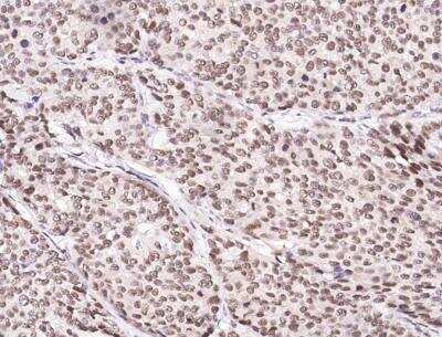 Immunohistochemistry-Paraffin: CUEDC2 Antibody (003) [NBP2-89902] - Staining of human CUEDC2 in human breast carcinoma with rabbit monoclonal antibody (1:1000).