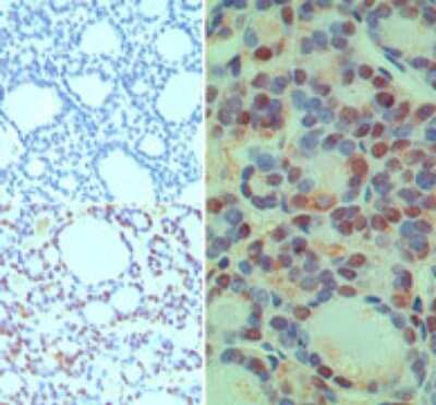 Immunohistochemistry-Paraffin: CUEDC2 Antibody [NBP2-24684] - Analysis of CUEDC2 in formalin-fixed paraffin-embedded human thyroid tissue using an isotype control (top left) and this antibody (bottom left, right) at 5 ug/ml.
