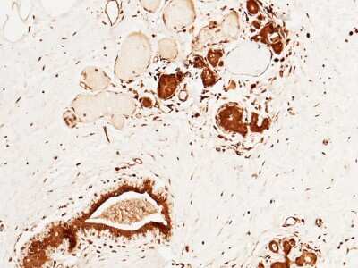 Immunohistochemistry-Paraffin: CUEDC2 Antibody [NBP2-99801] - Immunochemical staining of human CUEDC2 in human breast carcinoma with rabbit polyclonal antibody at 1:5000 dilution, formalin-fixed paraffin embedded sections.