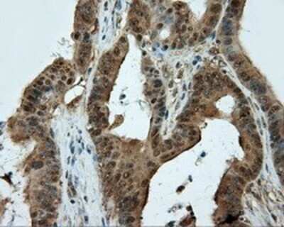 Immunohistochemistry: CUGBP1/CELF1 Antibody (OTI5B8) - Azide and BSA Free [NBP2-71623] - Staining of paraffin-embedded Adenocarcinoma of colon tissue using anti-CUGBP1 mouse monoclonal antibody.