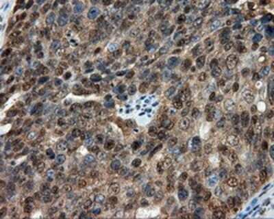 Immunohistochemistry: CUGBP1/CELF1 Antibody (OTI5B8) - Azide and BSA Free [NBP2-71623] - Staining of paraffin-embedded Adenocarcinoma of ovary tissue using anti-CUGBP1 mouse monoclonal antibody.