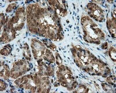 Immunohistochemistry: CUGBP1/CELF1 Antibody (OTI5B8) - Azide and BSA Free [NBP2-71623] - Staining of paraffin-embedded Carcinoma of prostate tissue using anti-CUGBP1 mouse monoclonal antibody.