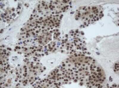 Immunohistochemistry: CUL4B Antibody (OTI1C4) - Azide and BSA Free [NBP2-71373] - Analysis of Carcinoma of Human pancreas tissue.