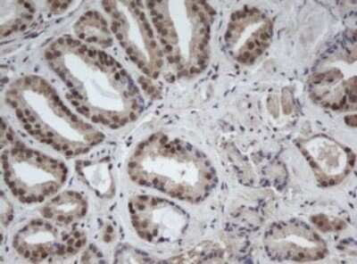 Immunohistochemistry: CUL4B Antibody (OTI1C4) - Azide and BSA Free [NBP2-71373] - Analysis of Carcinoma of Human prostate tissue.