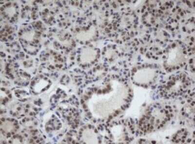 Immunohistochemistry: CUL4B Antibody (OTI1C4) - Azide and BSA Free [NBP2-71373] - Analysis of Carcinoma of Human thyroid tissue.