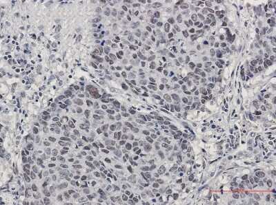 Immunohistochemistry-Paraffin: CUL4B Antibody (S06-3D3) [NBP3-15016] - Immunohistochemistry of CUL4B in paraffin-embedded Human lung cancer tissue using Cullin 4A/B Rabbit mAb at dilution 1/50