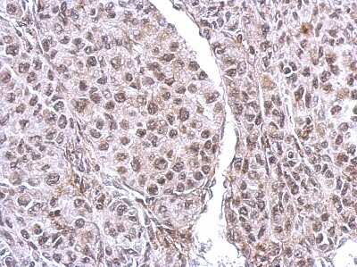 Immunohistochemistry-Paraffin: CUTC Antibody [NBP2-16038] - Immunohistochemical analysis of paraffin-embedded SkHep1 xenograft, using antibody at 1:500 dilution.