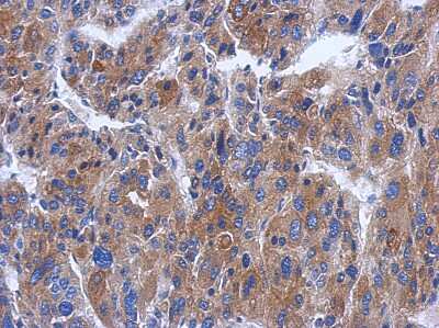 Immunohistochemistry-Paraffin: CWF19L1 Antibody [NBP2-16040] - Immunohistochemical analysis of paraffin-embedded HEPATOMA, using antibody at 1:500 dilution.