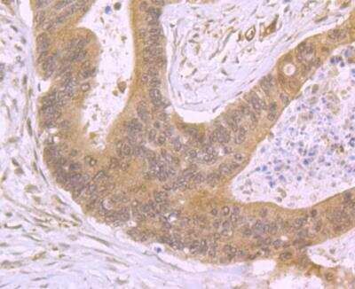 Immunohistochemistry-Paraffin: CXCL12/SDF-1 Antibody [NBP2-89133] - Analysis of paraffin-embedded human colon cancer tissue using anti-SDF1 antibody. Counter stained with hematoxylin.