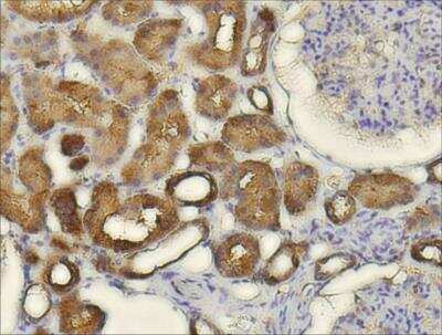 Immunohistochemistry-Paraffin: CXCL14/BRAK Antibody [NBP1-31398] - Human renal cell carcinoma , using CXCL14 antibody at 1:100 dilution. Antigen Retrieval: Trilogy™ (EDTA based, pH 8.0) buffer, 15min. 