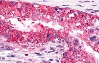 Immunohistochemistry-Paraffin: CXCR6 Antibody [NLS1102] - Analysis of anti-CXCR6 antibody with human lung, adenocarcinoma.