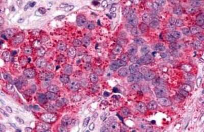 Immunohistochemistry-Paraffin: CXCR6 Antibody [NLS1102] - Analysis of anti-CXCR6 antibody with human ovary, carcinoma.