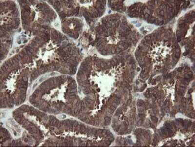 Immunohistochemistry: CXorf26 Antibody (5A11) [NBP2-46410] - Analysis of Adenocarcinoma of Human endometrium tissue.